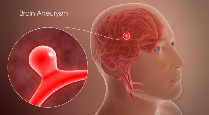 12 signs that may signal a brain aneurysm — Don’t ignore them