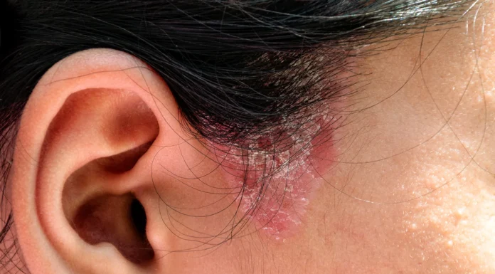 9 Powerful Home Remedies to Get Rid of Fungal Infection (Daad, Khaj, Khujli) Fast