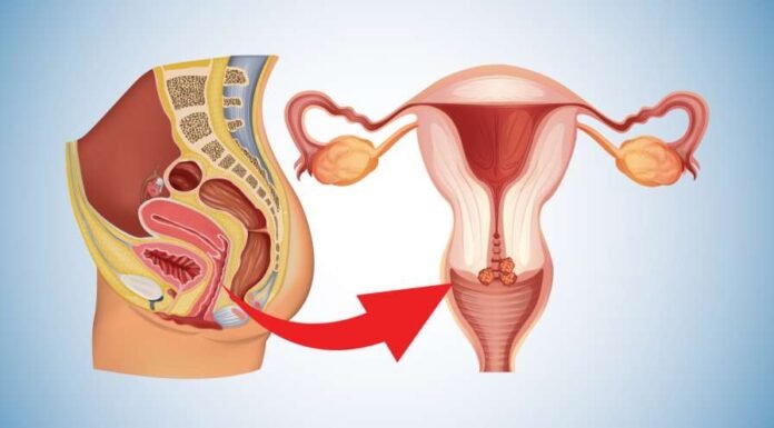 Cervical Cancer: Early Signs and Symptoms You Should Never Ignore