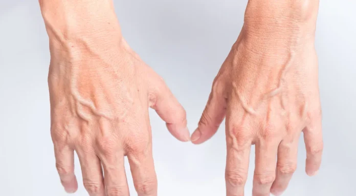 When to Worry About Veins That Appear Out of Nowhere