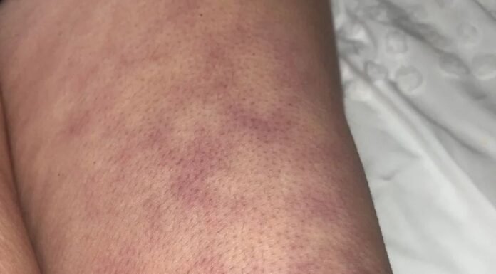 What those strange skin patterns might really mean