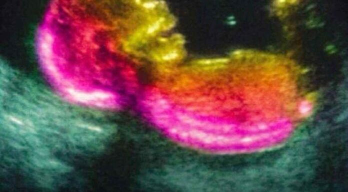 Study identifies possible connection to autism development