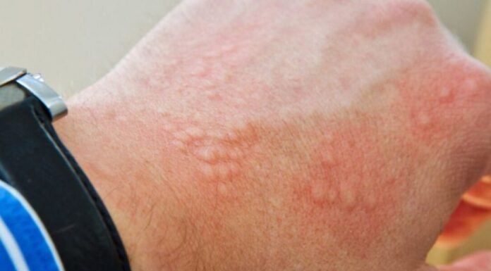 How to Reduce Skin Irritation: Causes, Remedies, and Prevention Tips