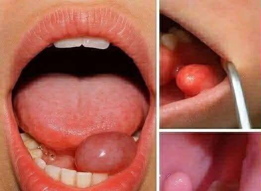 Hidden Dangers in Your Mouth: Early Signs of Oral Cancer