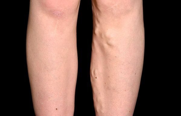 Tired of Poor Circulation and Varicose Veins? Try These 6 Effective Tips!