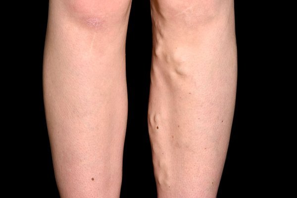 C0370877-Varicose_veins.max-600x600