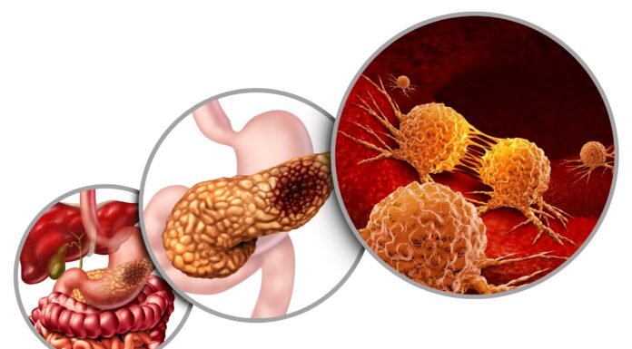 10 Signs of Pancreatic Cancer You Should Never Ignore