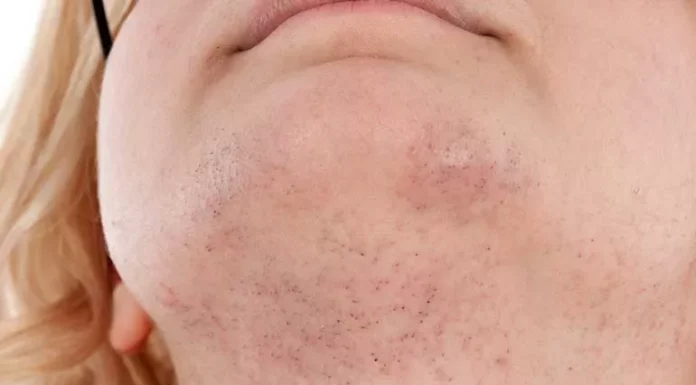 Chin Whiskers in Women