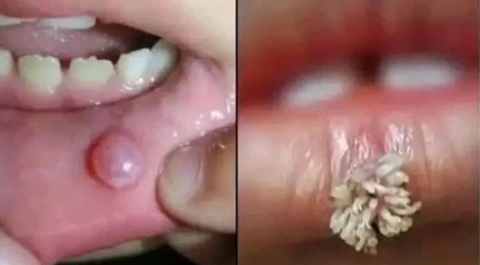 Be very careful if it comes out in your mouth, you are infected