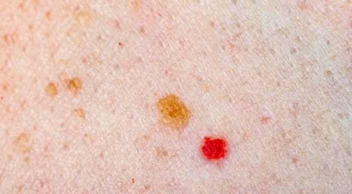 11 Reasons Why You Have Red Dots On Your Skin