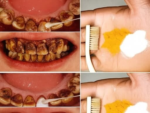 Whiten Your Teeth in Just 2 Minutes!