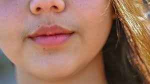 Chin Whiskers in Women