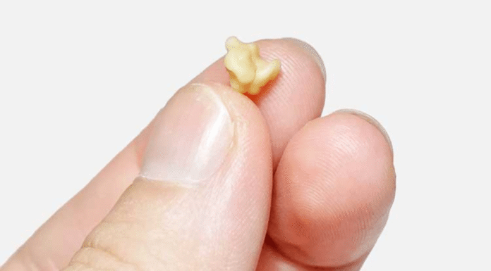 Everything you need know about tonsil stones, odd growths that seem like pimples in your throat.