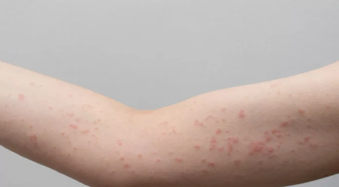 Surprising Causes of Hives Revealed — What May Be Triggering Your Skin Reaction