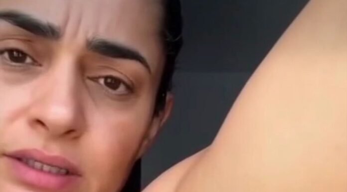 Their acne is severe