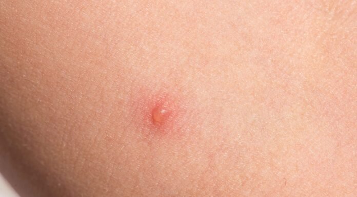 Noticing Itchy Red Bumps? Here’s What They Might Mean