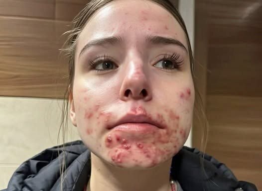 The Hidden Reasons You Keep Getting Pimples on Your Chin