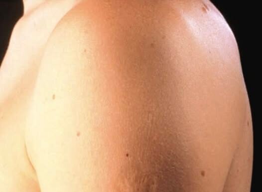 Here’s The Truth Behind This Scar On People’s Upper Left Arm