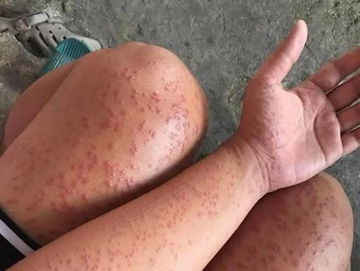 I Slept at my friends old apartment for a couple days noticed these weird bump…