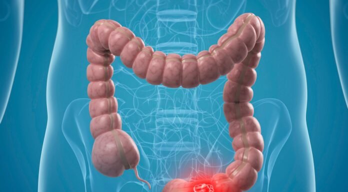 Woman reveals 5 colon cancer symptoms that shouldn’t be ignored