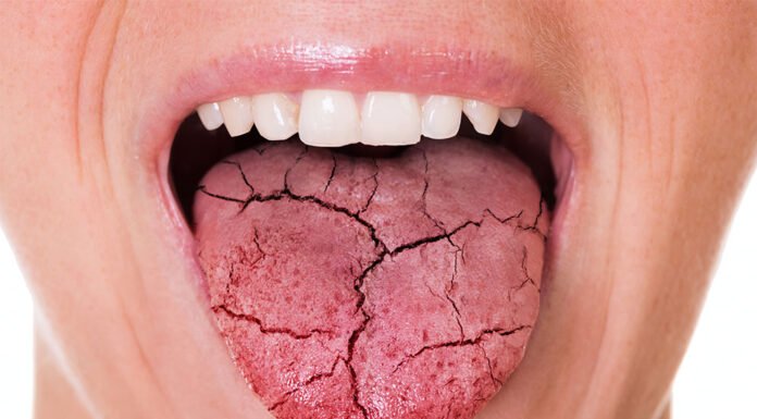 When you SHOULD be worried about about a crusty tongue