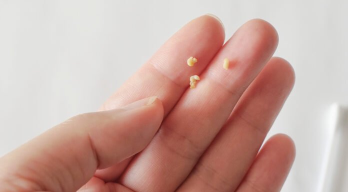 What are those ‘white stones’ that appear in the mouth and cause bad breath?