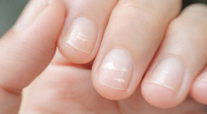 If you have these lines on your nails after 40, it is a clear sign that..