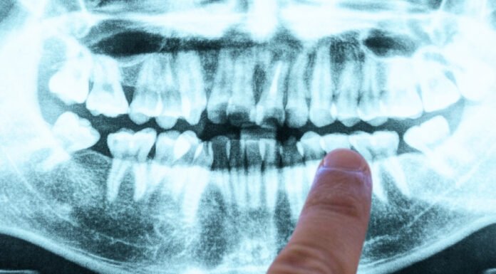 The cause of Alzheimer’s may lie within your mouth