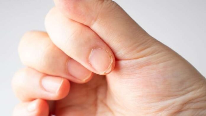 nail-brittleness-760x428