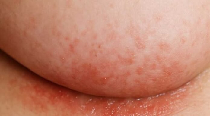 An itchy rash keeps flaring up under my bre*sts in winter, but my doctor isn’t available right now. What can I do today?