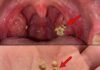 Tonsil Stones: Discover what they are, how they appear, and how to get rid of them forever.