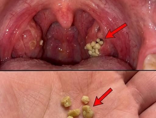 Tonsil Stones: Discover what they are, how they appear, and how to get rid of them forever.