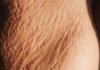 Stretch Marks: Causes, Prevention, and How to Handle Them Effectively