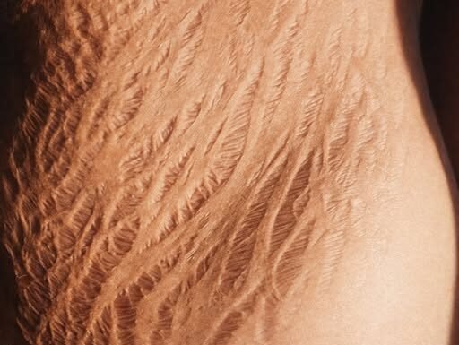 Stretch Marks: Causes, Prevention, and How to Handle Them Effectively