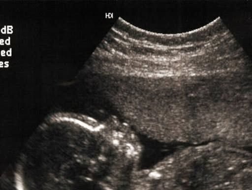 Scientists May Have Found One of the Causes of Autism