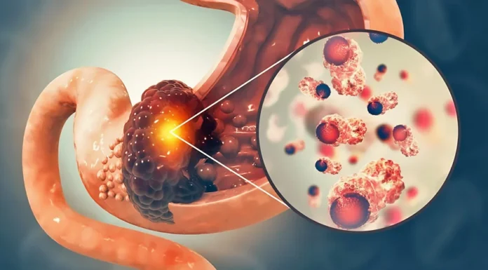 Stomach Can-cer: The “Silent Disease” You Shouldn’t Ignore