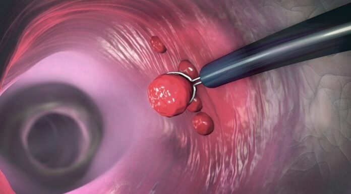 Colon Polyps and Can.cer Prevention: Why Early Detection Matters