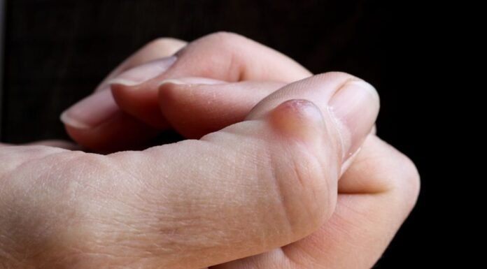 Noticing a Lump on Your Hand