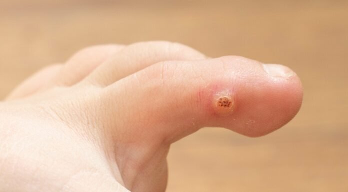 Plantar warts on the feet: what they are and why they shouldn’t be mistaken for a regular callus