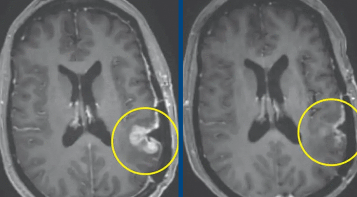 Woman’s inoperable tumor shrinks within five days following breakthrough cancer treatment