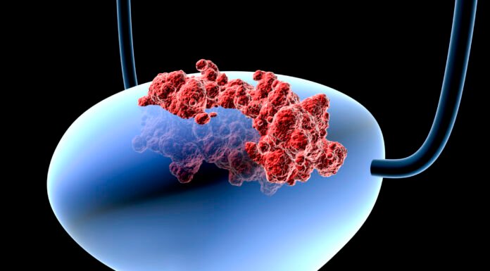 Bladder Cancer Often Starts Quietly: 5 Early Symptoms to Watch For