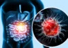 50% of Colon Cancer Cases Could Be Prevented If We Did These 9 Things