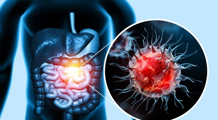 50% of Colon Cancer Cases Could Be Prevented If We Did These 9 Things