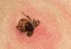Why You Should Never Flush A Tick Down The Toilet
