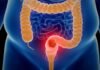 How Your Bowel Movements Reveal Clues About Colon Cancer