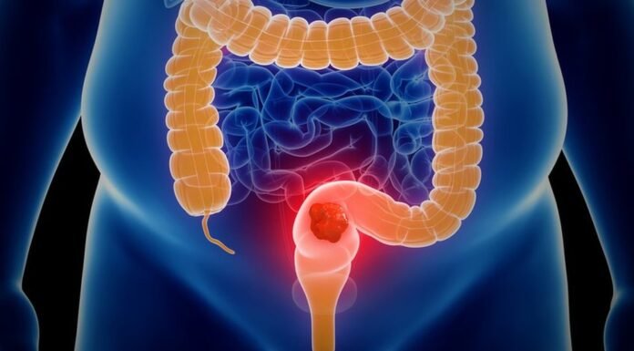How Your Bowel Movements Reveal Clues About Colon Cancer