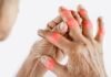 Rheumatoid Arthritis: Foods Which Should Be Avoided