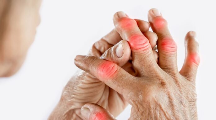 Rheumatoid Arthritis: Foods Which Should Be Avoided