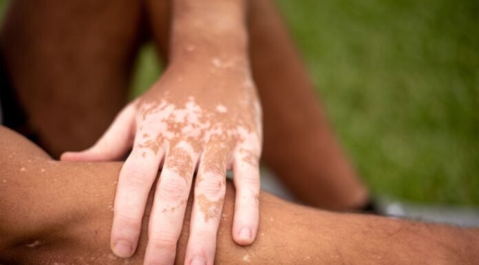 The mystery of the pale patch: A deep dive into small white spots on your skin