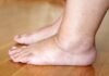 Why Do Seniors Experience Swollen Legs? Causes and Simple Solutions